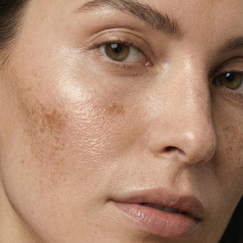 Why your pigmentation won't fade